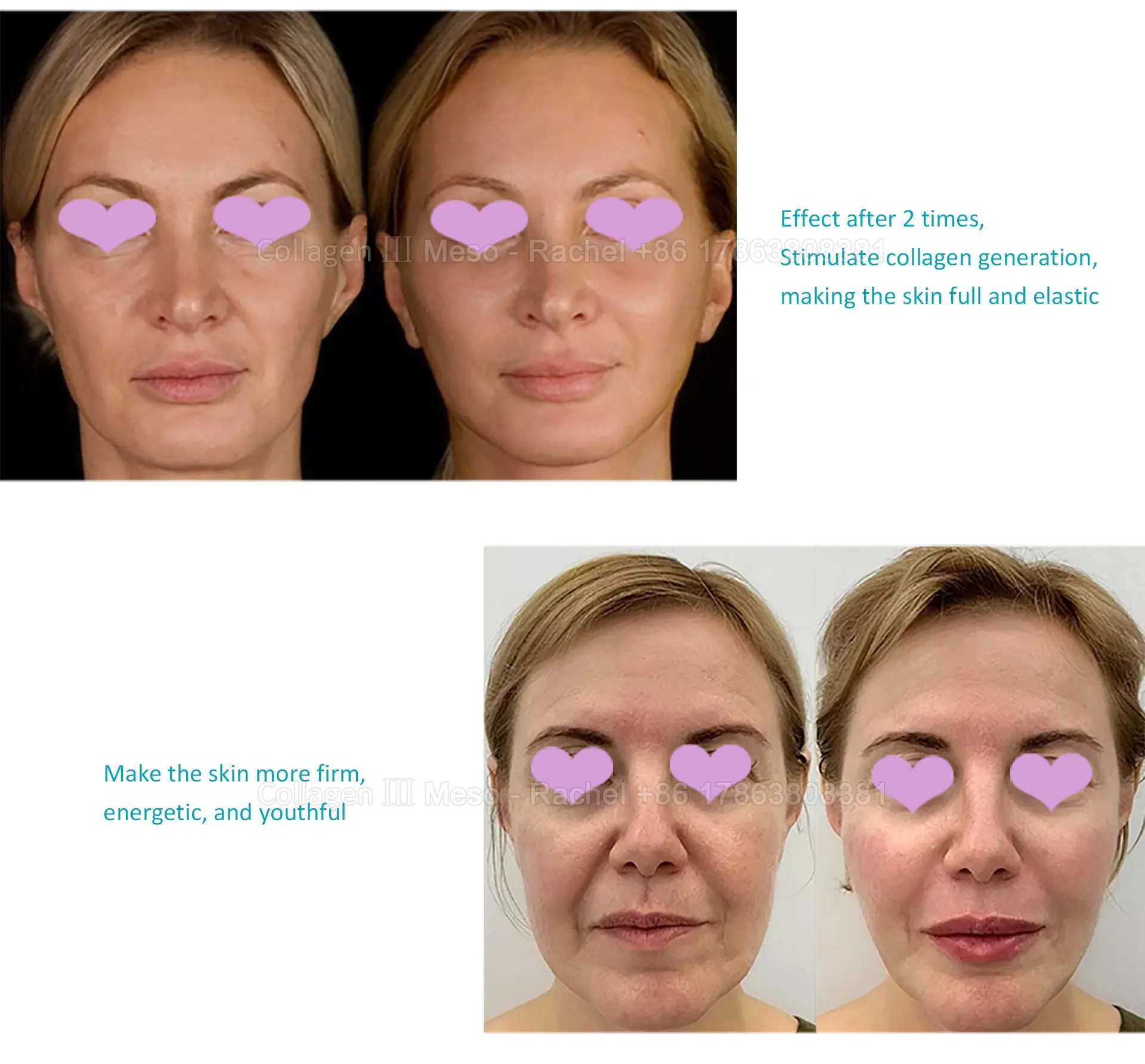 Collagen III Premium Meso 5ml × 5 — Premium Meso / Collagen product image 5