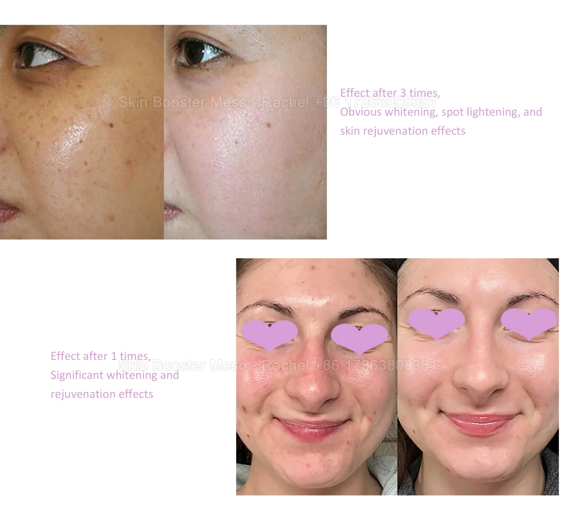 Skin Booster Premium Meso 5ml × 5 — Premium Meso / Skin Booster product image 5